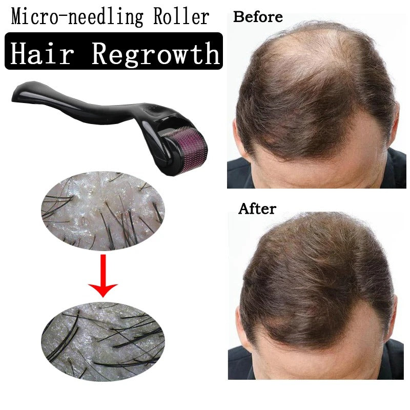 540 Derma Roller Micro Needle for Face & Skin Care – Microneedling Therapy for Rejuvenation & Hair Growth